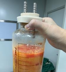 淄博水动力吸脂手术要做多久？